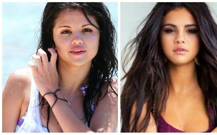 Zvezde pred in po plastični operaciji. Ali je imela Selena Gomez plastično operacijo?