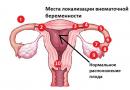 Может ли быть внематочная беременность при эко, и какие последствия ожидают Признаки внематочной после эко