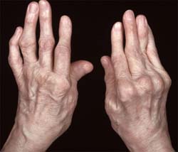 térdízület kezelése chlamydialis arthritis