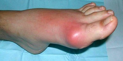 a lábujjak posztraumás ízületi gyulladása